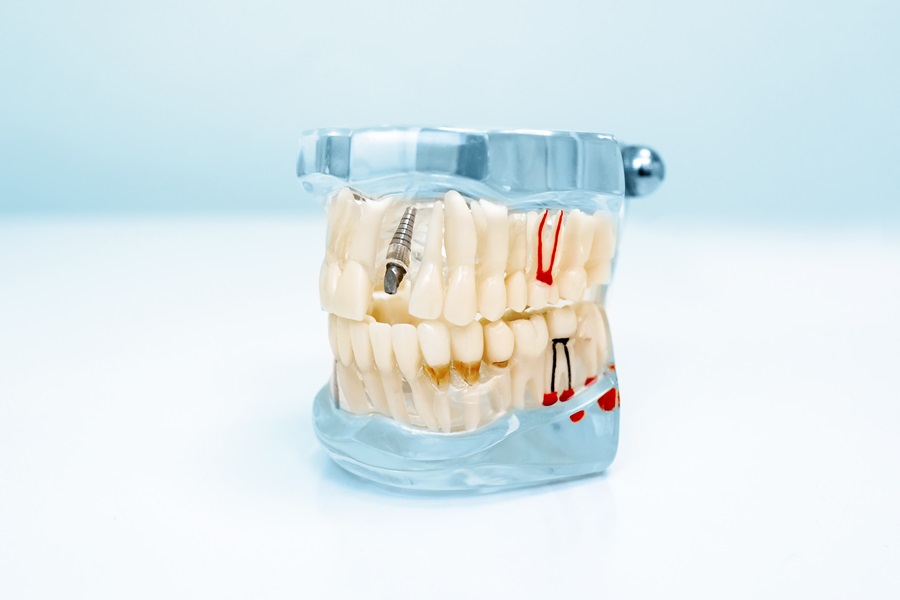 BENEFITS OF DENTAL IMPLANTS OVER DENTURES
